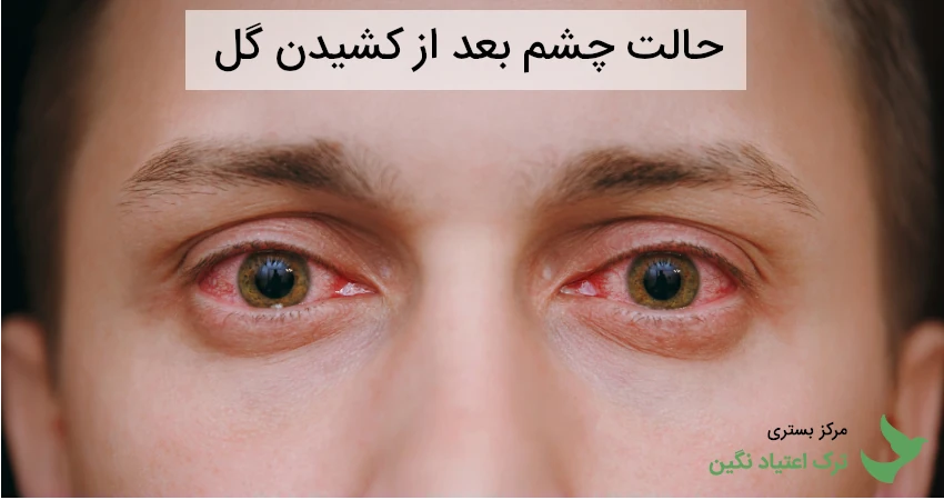حالت چشم بعد از کشیدن گل